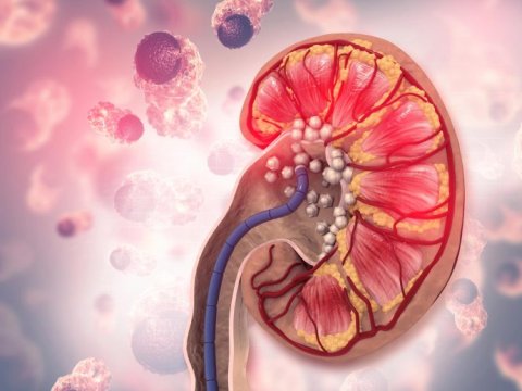 Detailed Medical Illustration of Kidney with Kidney Stones